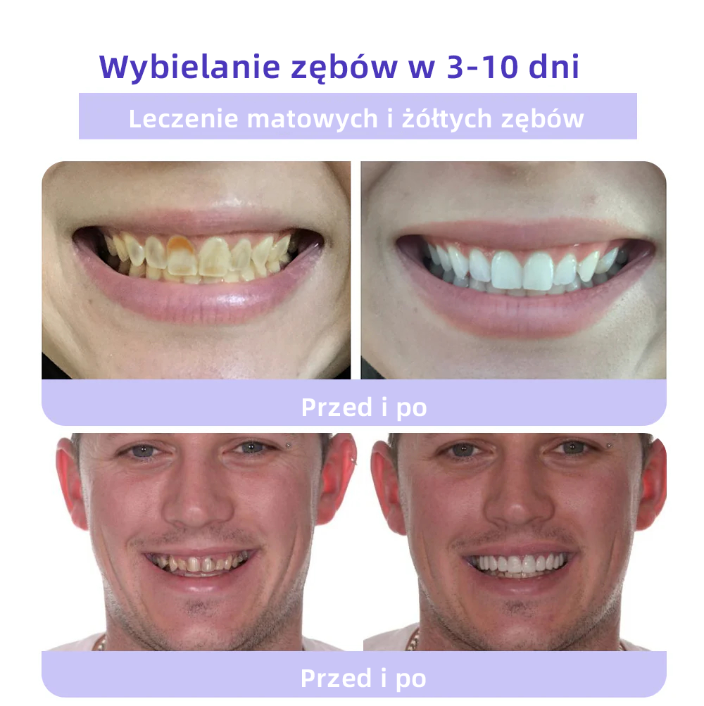 [✅Oficjalny sklep] 𝐎𝐲𝐢𝐤𝐞𝐲™ Mineralny proszek do naprawy zębów 🦷 (Zalecany przez PTO) (🎁 Ekskluzywna oferta – nie przegap!)